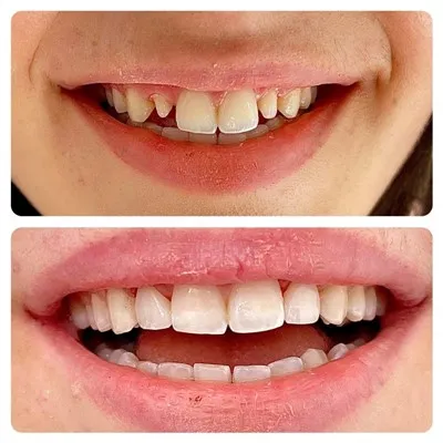 Fixed Dental Bridges